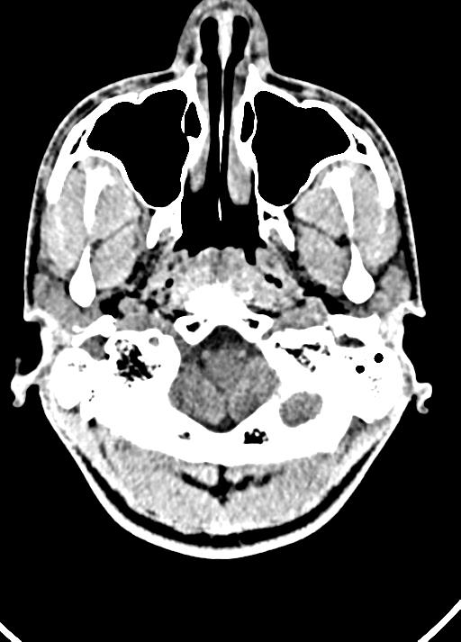 Cavum septum pellucidum and cavum vergae (Radiopaedia 77797-90060 Axial Brain Window 12).jpg
