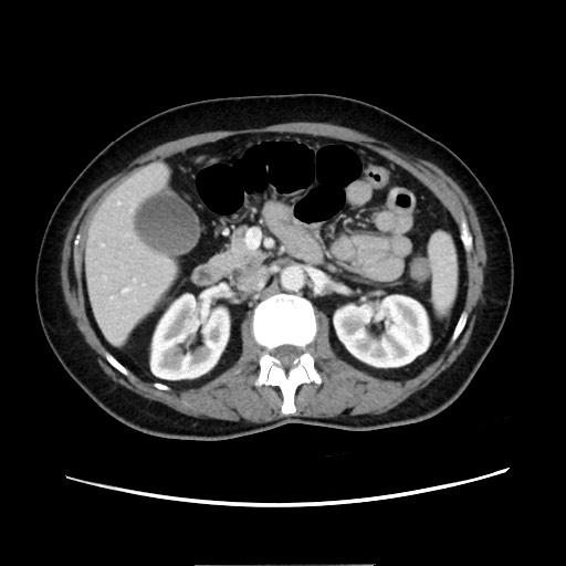 Cecal adenocarcinoma (Radiopaedia 75909-87331 A 36).jpg