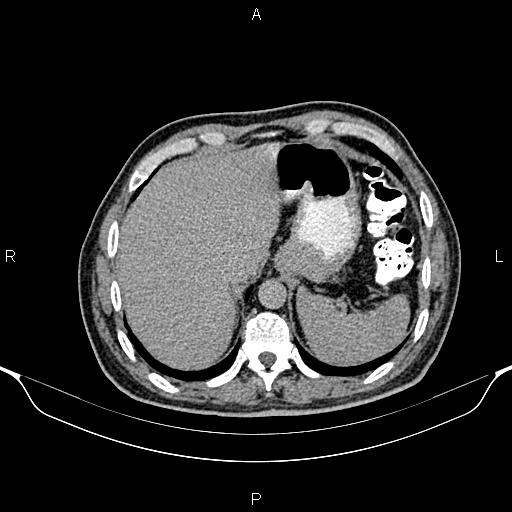 Cecal adenocarcinoma (Radiopaedia 85324-100916 Axial C+ delayed 17).jpg