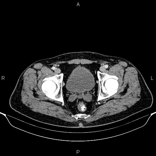 Cecal adenocarcinoma (Radiopaedia 85324-100916 B 93).jpg