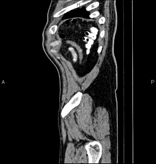 Cecal adenocarcinoma (Radiopaedia 85324-100916 E 88).jpg