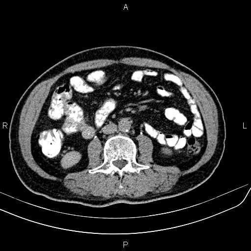File:Cecal cancer with appendiceal mucocele (Radiopaedia 91080-108651 Axial C+ delayed 35).jpg