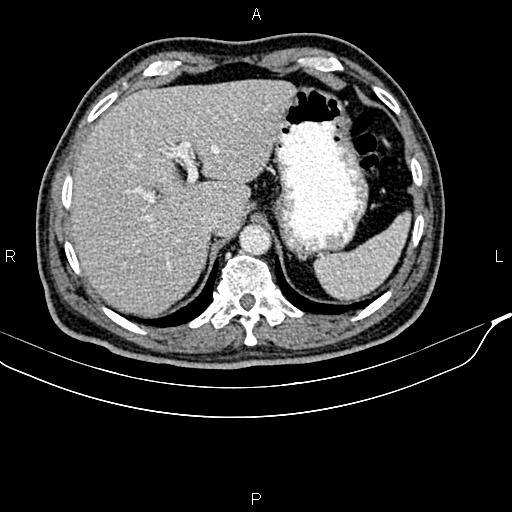 File:Cecal cancer with appendiceal mucocele (Radiopaedia 91080-108651 B 23).jpg