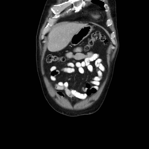 File:Cecal mass causing appendicitis (Radiopaedia 59207-66531 B 8).jpg