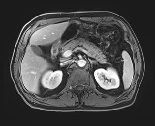 Cecal mass causing appendicitis (Radiopaedia 59207-66532 T1 C+ PV phase 49).jpg