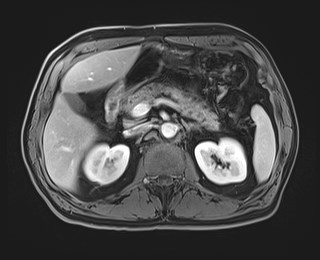 Cecal mass causing appendicitis (Radiopaedia 59207-66532 T1 C+ PV phase 50).jpg