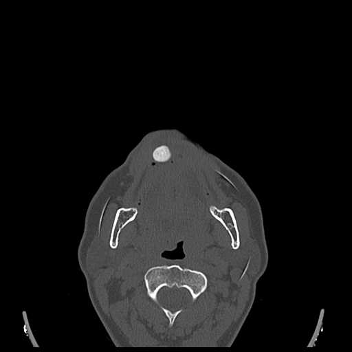File:Cemento-ossifying fibroma (Radiopaedia 21243-21149 Axial bone window 10).jpg