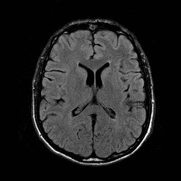 File:Central-variant posterior reversible encephalopathy syndrome (PRES) (Radiopaedia 43880-47359 Axial FLAIR 13).jpg