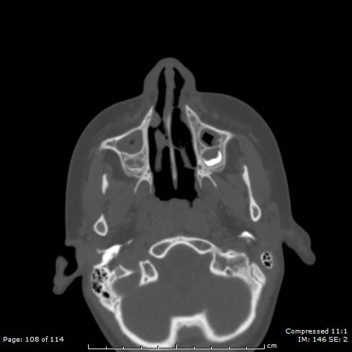 File:Central giant cell granuloma (Radiopaedia 45612-49754 Axial bone window 54).jpg