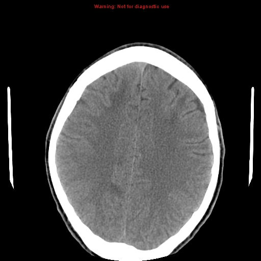File:Central nervous system vasculitis (Radiopaedia 8410-9234 Axial non-contrast 19).jpg