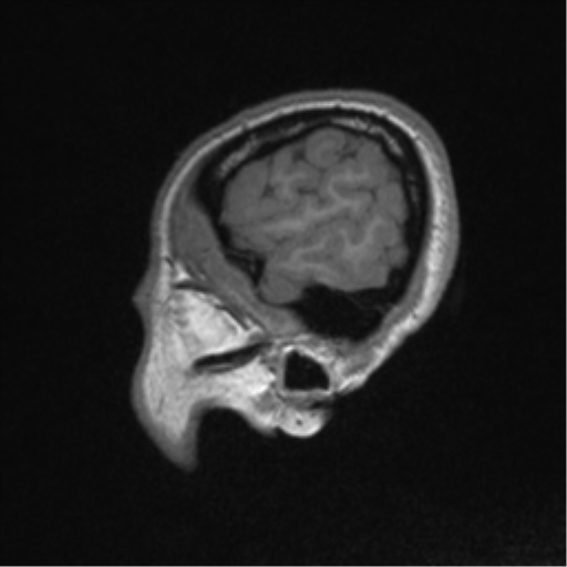 Central neurocytoma (Radiopaedia 37664-39557 Sagittal T1 85).png