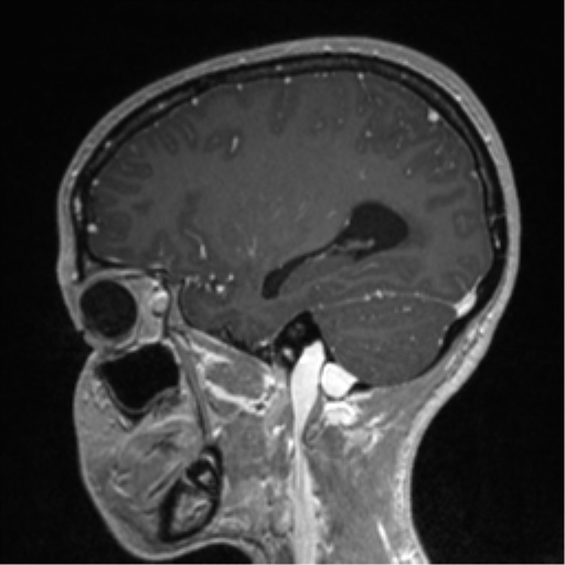 Central neurocytoma (Radiopaedia 37664-39557 Sagittal T1 C+ 68).png
