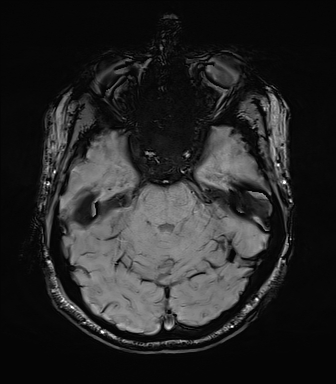 File:Central neurocytoma (Radiopaedia 71068-81303 Axial SWI 16).jpg