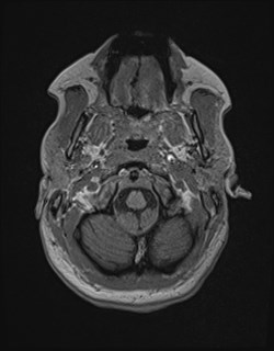 Central neurocytoma (Radiopaedia 84497-99872 Axial T1 29).jpg