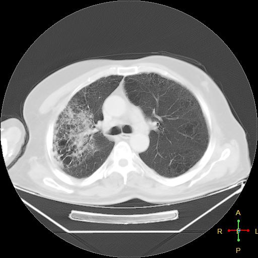 File:Centrilobular emphysema - with superimposed infection (Radiopaedia 24389-24683 lung window 11).jpg