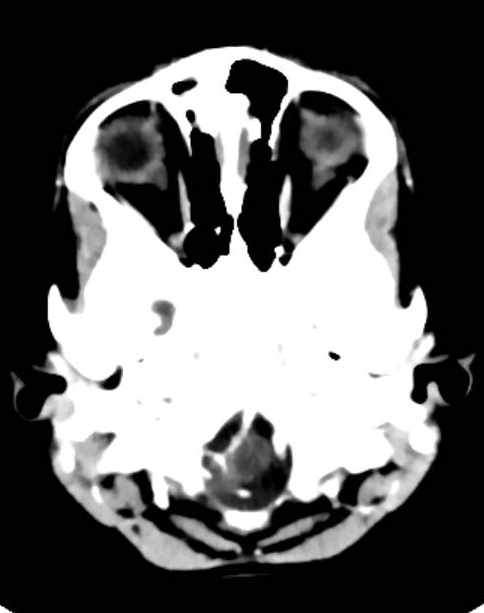 Cerebellar abscess (Radiopaedia 73727-84527 Axial C+ 9).jpg