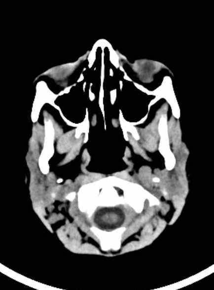 Cerebellar abscess (Radiopaedia 73727-84527 Axial non-contrast 16).jpg