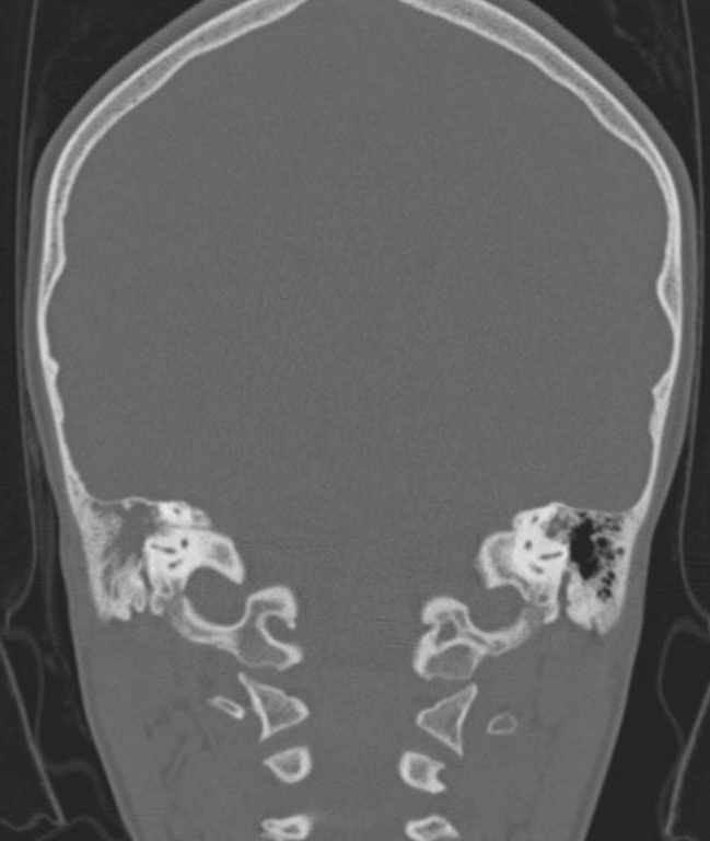 Cerebellar abscess (Radiopaedia 73727-84527 Coronal bone window 47).jpg