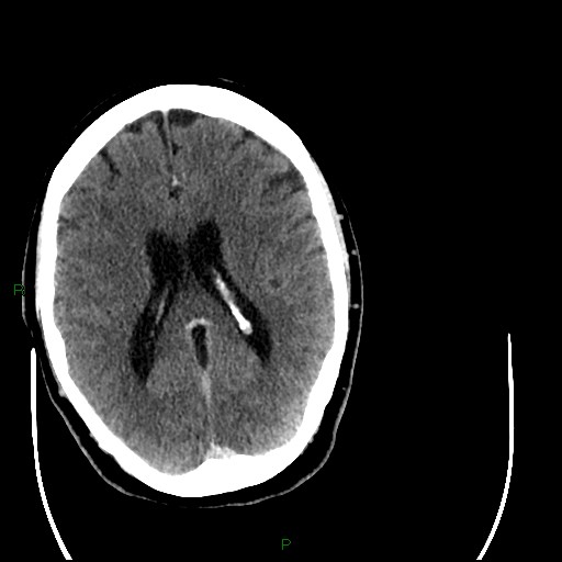 Cerebellar abscess (Radiopaedia 78135-90671 Axial C+ delayed 64).jpg
