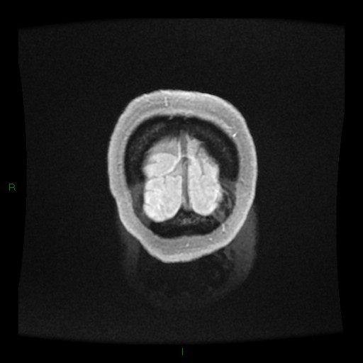 Cerebellar abscess (Radiopaedia 78135-90678 Coronal T1 C+ 168).jpg