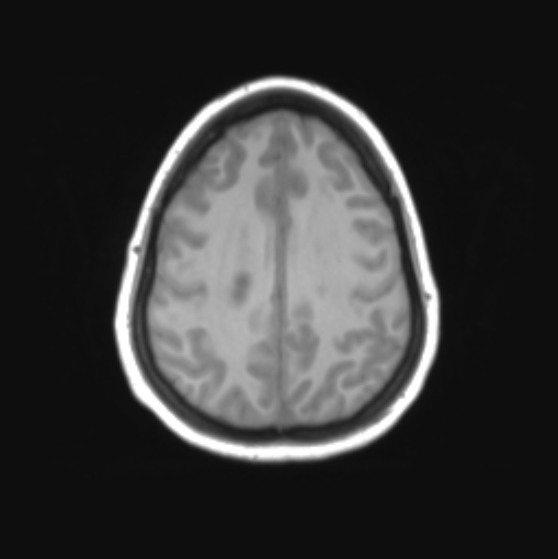 File:Cerebellar ependymoma complicated by post-operative subdural hematoma (Radiopaedia 83322-97736 Axial T1 31).png