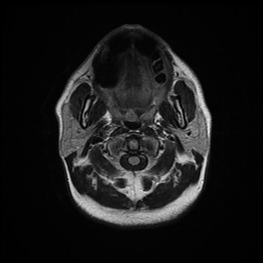 File:Cerebellar hemangioblastoma (Radiopaedia 88055-104622 Axial FLAIR 2).jpg