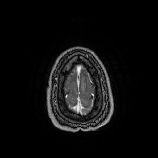 Cerebellar hemangioblastoma (Radiopaedia 88055-104622 Axial T1 C+ 160).jpg
