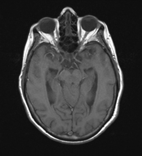 File:Cerebellar metastases (Radiopaedia 24038-24249 Axial T1 9).jpg