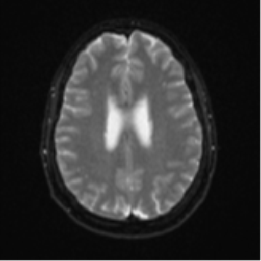 Cerebellar metastasis (Radiopaedia 51137-56765 Axial DWI 19).png
