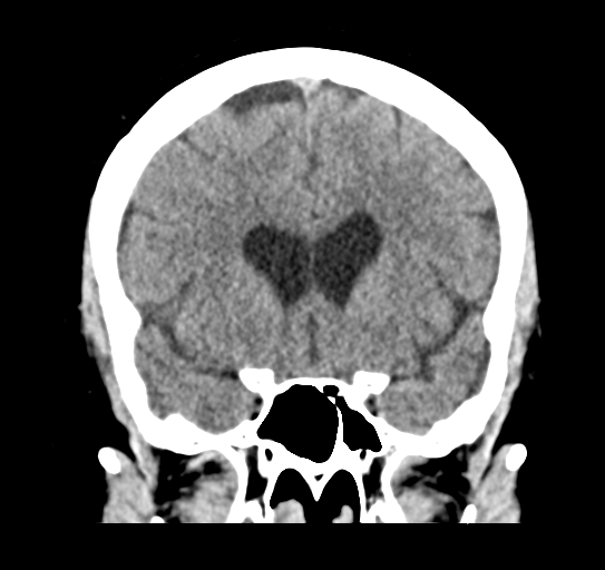 File:Cerebellar metastasis (Radiopaedia 54578-60812 Coronal non-contrast 20).png