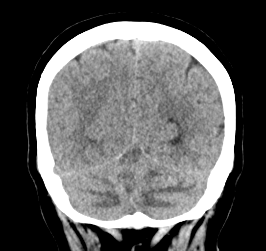 Cerebellar metastasis (Radiopaedia 54578-60812 Coronal non-contrast 47).png
