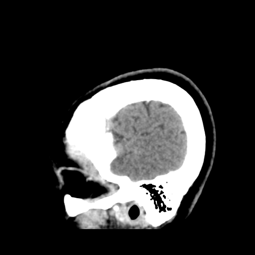 File:Cerebellar metastasis (cystic appearance) (Radiopaedia 41395-44258 F 46).png