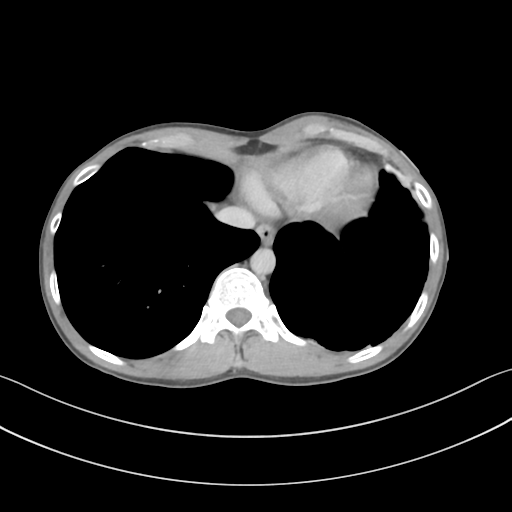 Cerebellar metastasis - adenocarcinoma lung (Radiopaedia 63184-71717 Axial C+ delayed 55).png