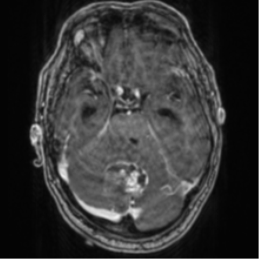 File:Cerebellar metastasis from lung adenocarcinoma (Radiopaedia 86690-102829 Axial T1 C+ 29).png