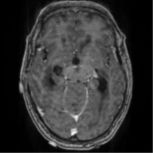 Cerebellar metastasis from lung adenocarcinoma (Radiopaedia 86690-102829 Axial T1 C+ 35).png