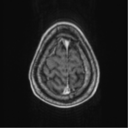 Cerebellar metastasis from lung adenocarcinoma (Radiopaedia 86690-102829 Axial T1 C+ 71).png