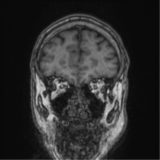 Cerebellar metastasis from lung adenocarcinoma (Radiopaedia 86690-102829 Coronal T1 79).png