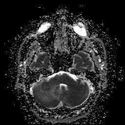 File:Cerebellar metastasis of pulmonary adenocarcinoma, cavernous venous malformation, and developmental venous anomaly (Radiopaedia 85827-101661 Axial ADC 9).jpg