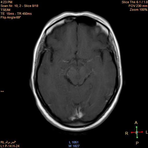 File:Cerebellopontine angle meningioma (Radiopaedia 22488-22525 Axial T1 C+ 7).jpg
