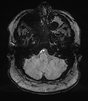 Cerebellopontine angle meningioma (Radiopaedia 48434-53348 Axial SWI 16).png