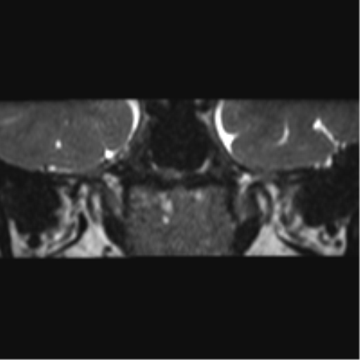 Cerebellopontine angle meningioma (Radiopaedia 48434-53348 Coronal T2 74).png