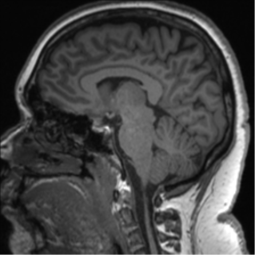 Cerebellopontine angle meningioma (Radiopaedia 48434-53348 Sagittal T1 50).png