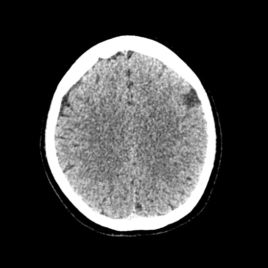 Cerebellopontine angle meningioma (Radiopaedia 53561-59592 Axial non-contrast 47).jpg