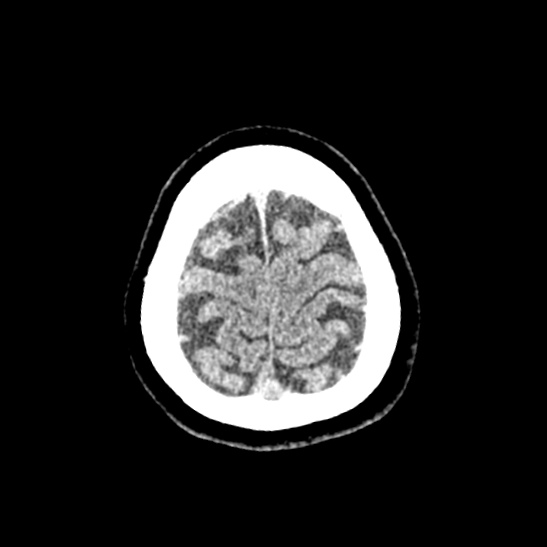 File:Cerebellopontine angle meningioma (Radiopaedia 53561-59592 Axial non-contrast 62).jpg