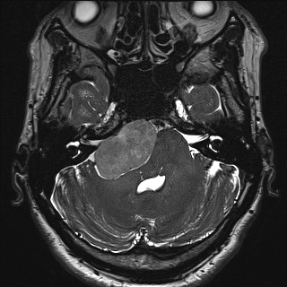 File:Cerebellopontine angle meningioma (Radiopaedia 72983-83680 Axial FIESTA 31).jpg