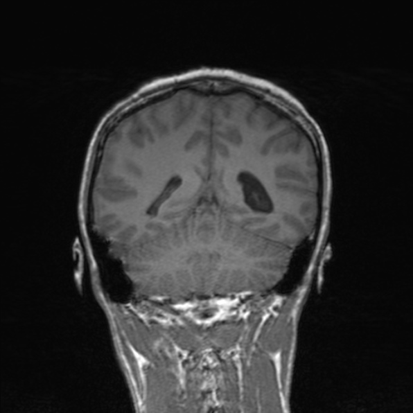 Cerebral abscess (Radiopaedia 24212-24478 Coronal T1 145).jpg