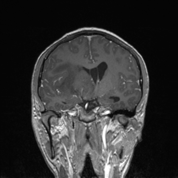 Cerebral abscess (Radiopaedia 24212-24478 Coronal T1 C+ 105).jpg