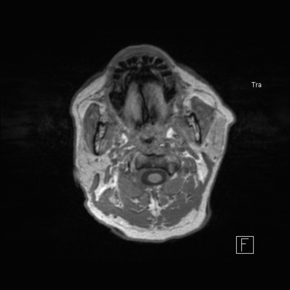Cerebral abscess (Radiopaedia 26111-26247 Axial T1 6).jpg