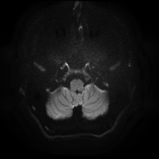 Cerebral abscess (Radiopaedia 57774-64740 Axial DWI 3).png
