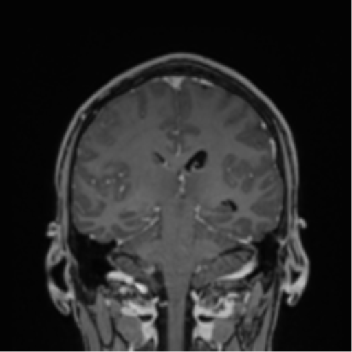 Cerebral abscess (Radiopaedia 60342-68009 H 19).png